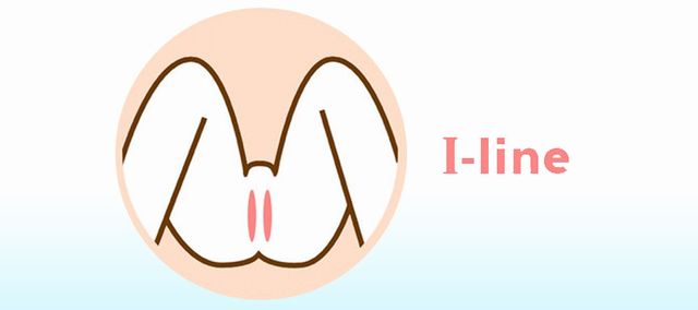 Iライン